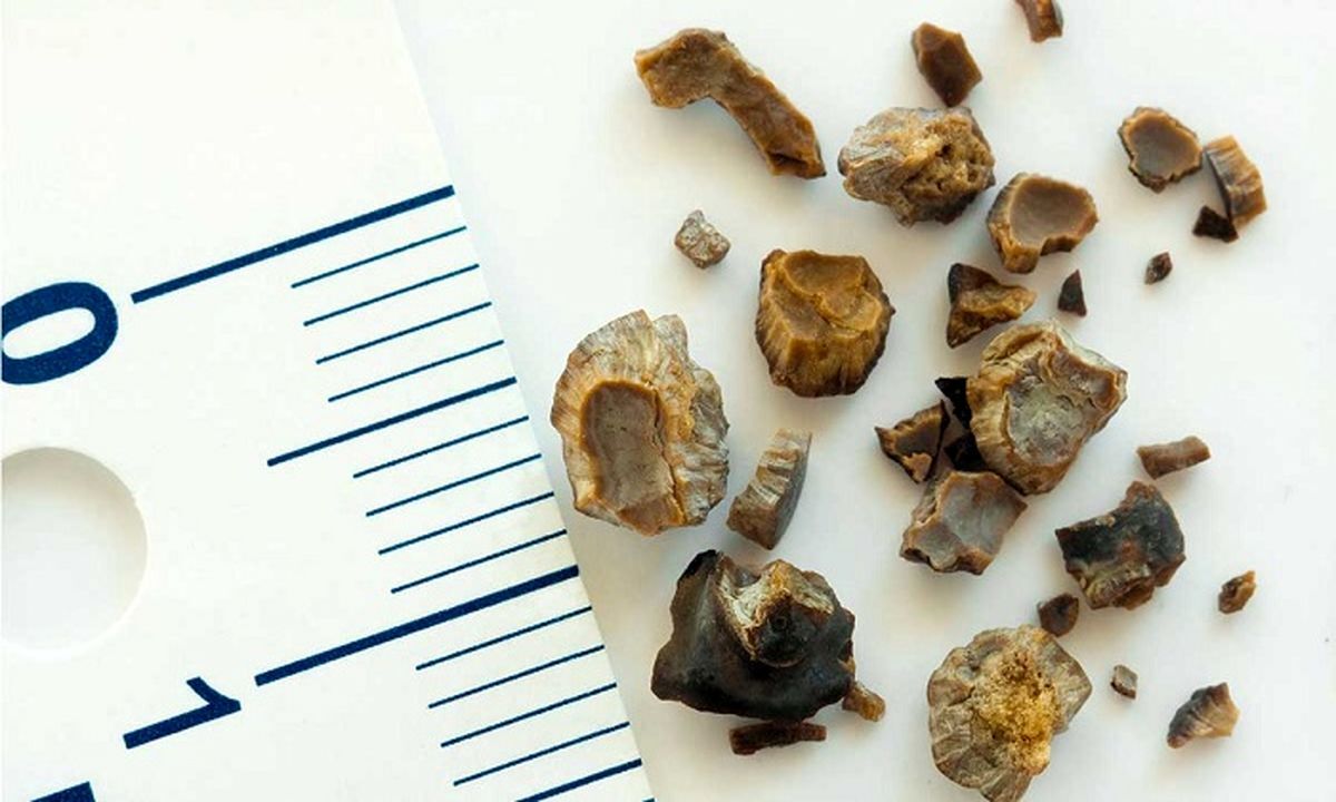 اگر سنگ کلیه دارید این دانه خوراکی رایج را اصلا نخورید!+عکس