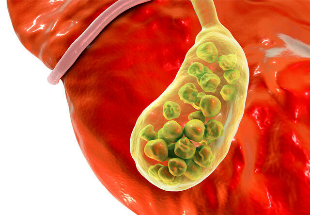 با چه روش هایی از بروز سنگ صفرا جلوگیری کنیم؟
