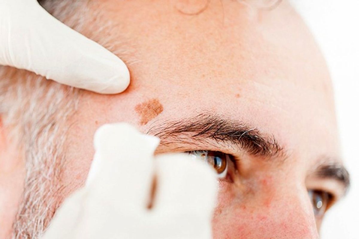 از زیاد شدن خال ها چه می دانید؟ / چه زمانی نگران افزایش خال ها باشیم؟