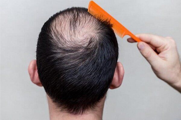 علائم ریزش مو کدامند؟ این ریزش مو مخصوص زنان است