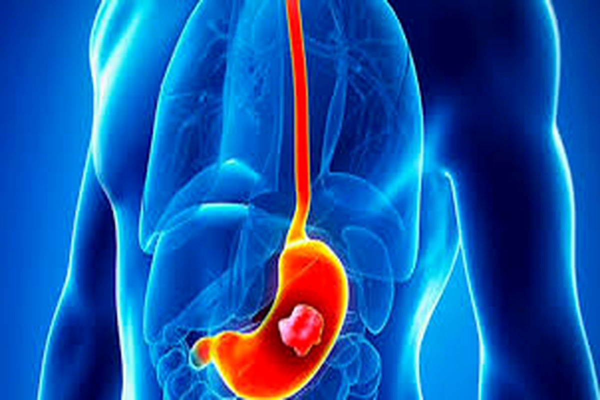 میکروب‌های معده را با این روش نابود کنید