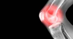 اقداماتی که برای مبتلایان به آرتروز باید انجام شود