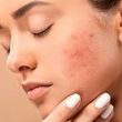 چند روش عالی که جای جوش صورت را محو می‌کند!