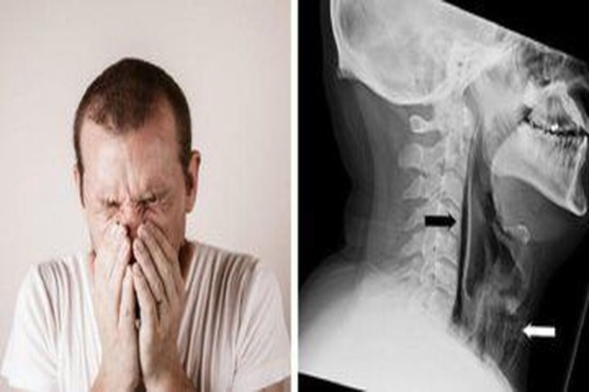 حادثه تکان دهنده برای یک مرد با نگهداشتن عطسه/ گلویش پاره شد + عکس