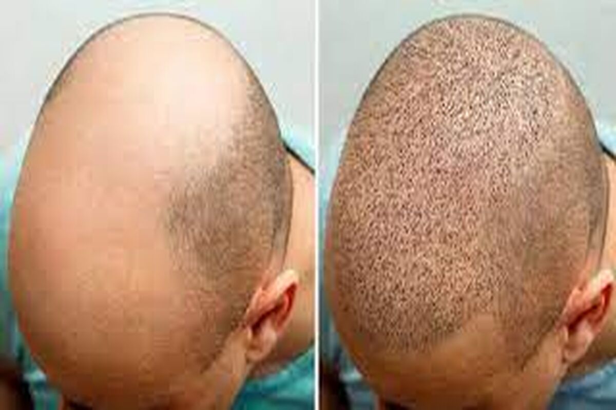 کاشت موی جنجالی این مرد کار دستش داد!