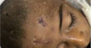 ماجرای مرگ کودک ۴ساله بر اثر کودک آزاری/ خانواده ادعا کرده‌اند؛ کودک از بالای درخت افتاده/عکس‌های +18