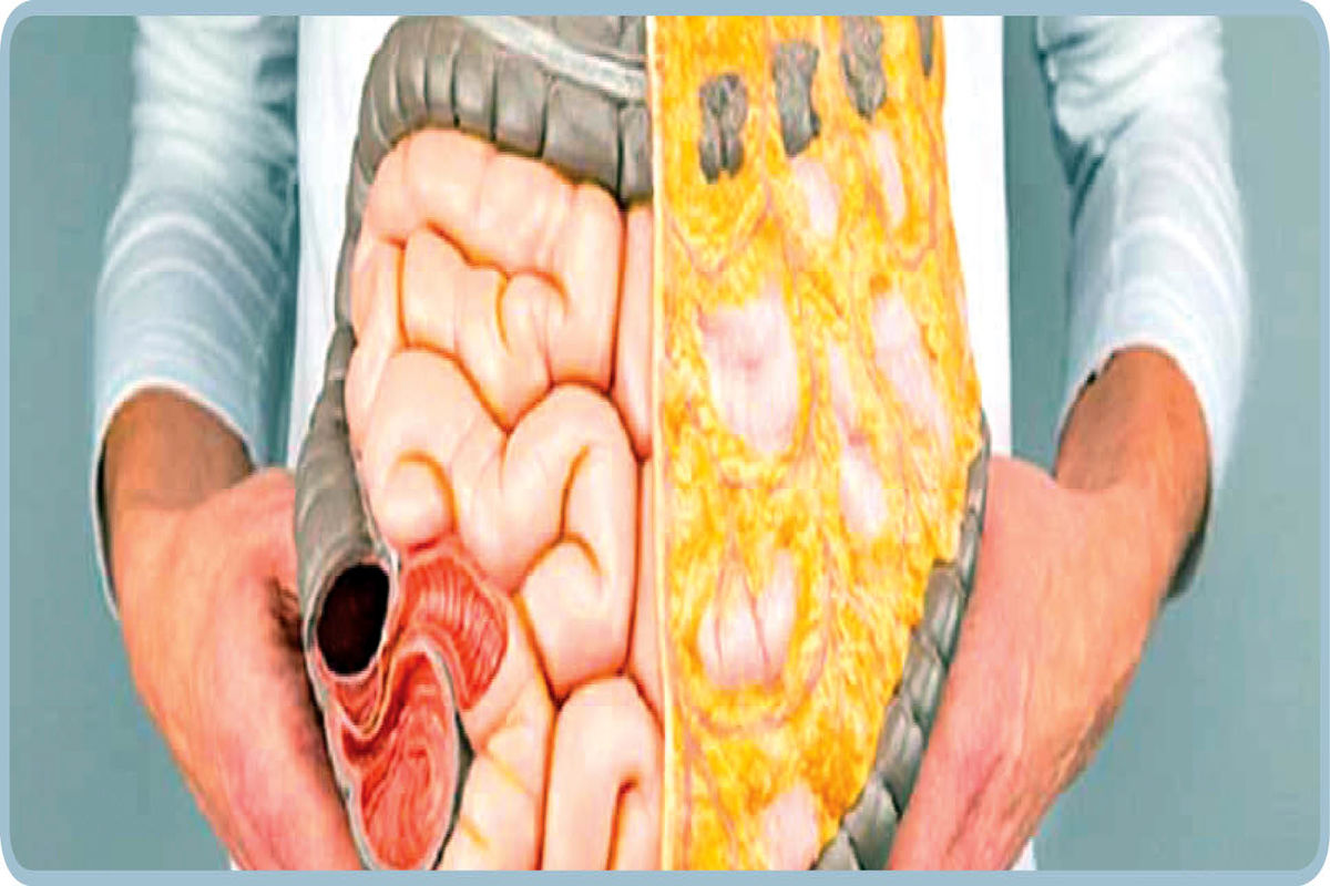 گیاهی مفید برای التهاب روده