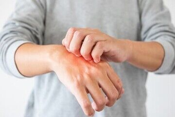 راه‌های پیشگیری از ابتلا به قارچ پوستی