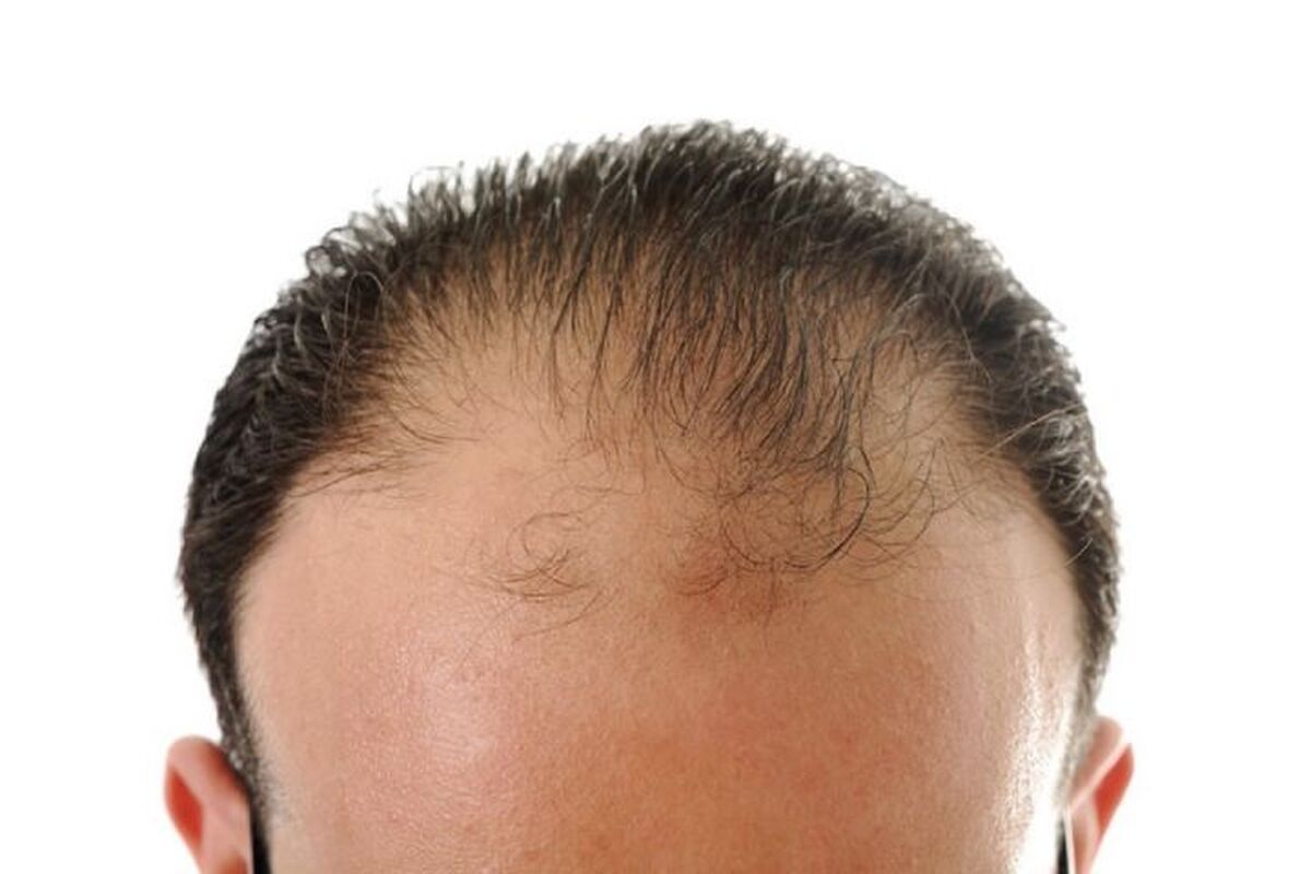 ترفندهای مناسب برای توقف ریزش مو