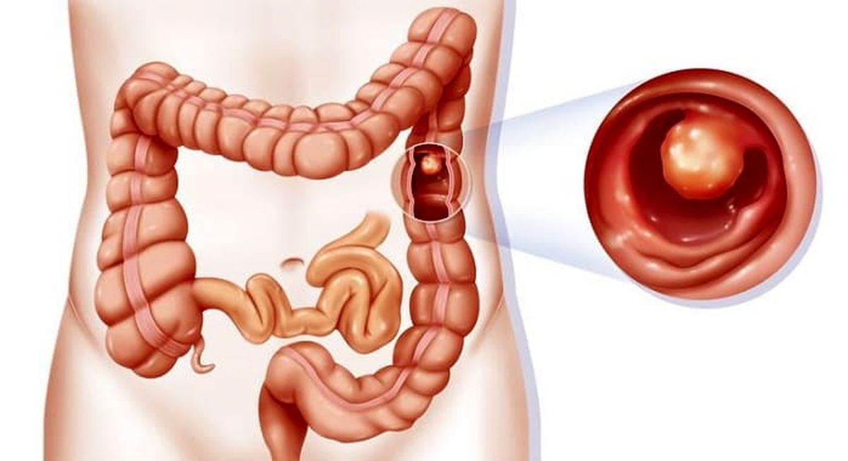 این مشکل پوستی می‌گوید که وضعیت روده‌هایتان خراب است! 