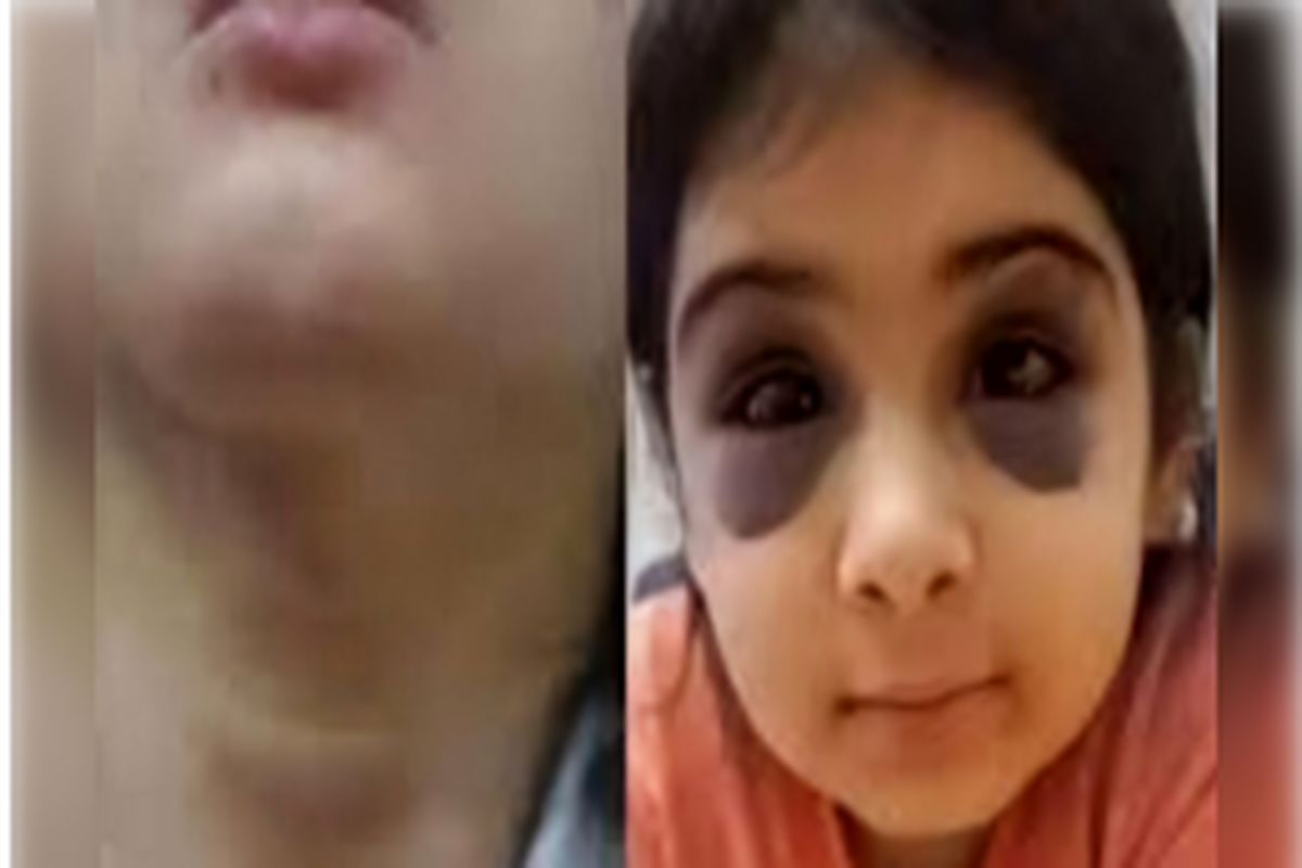 کودک‌آزاری تکان‌دهنده در این شهر/ کوبیدن گوشت کوب به سر دختر بچه بیچاره +عکس دردناک آنیلا