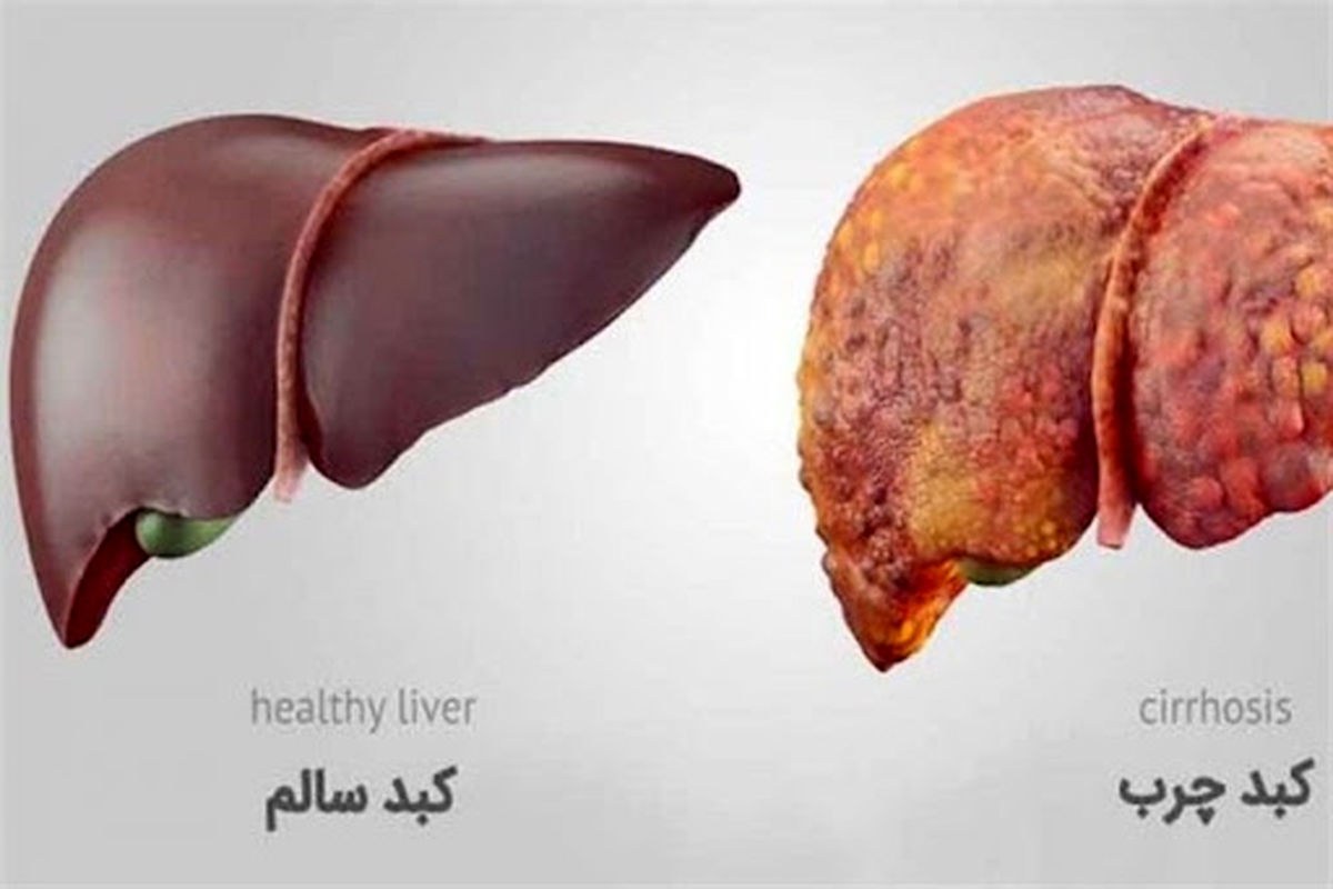 علت کبد چرب چیست/ دلایل اصلی ابتلا به این بیماری