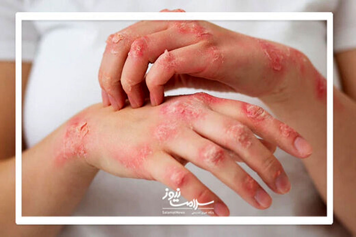 پسوریازیس چیست و چگونه درمان می‌شود؟