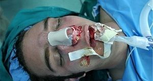 جراحی بینی بدون بیهوشی توسط دستیار دیپلمه پزشک مدعی!