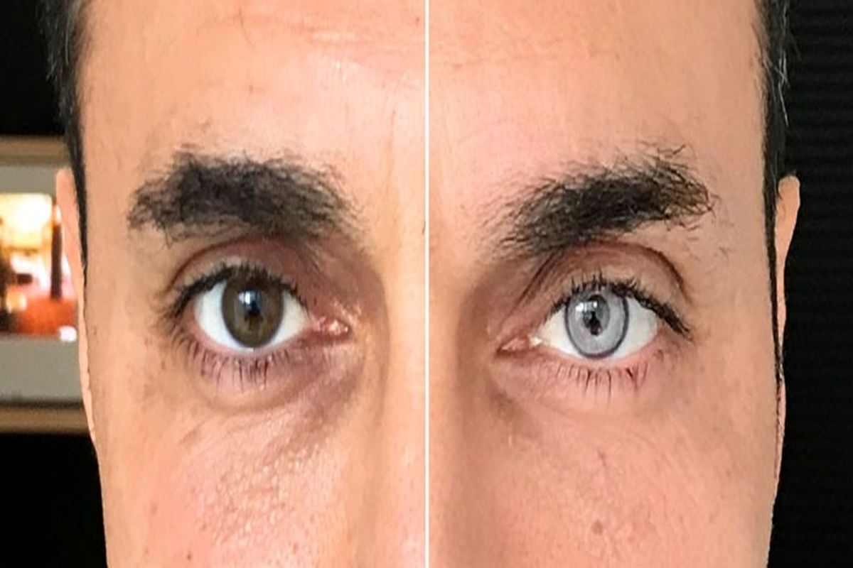 عوارض خال‌کوبی قرنیه را بشناسید